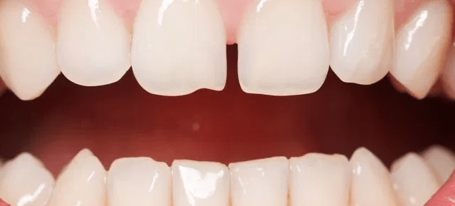 Qué es el diastema dental