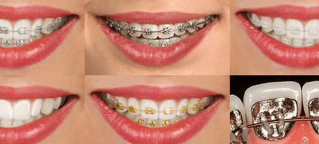 tipos de ortodoncias