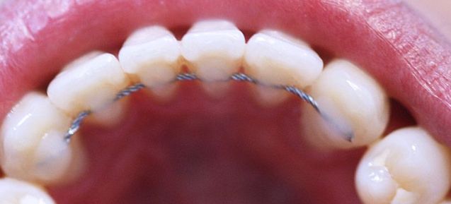 hasta ahora Explicación académico Los retenedores de ortodoncia fijos | Clínica Dental Guadentis